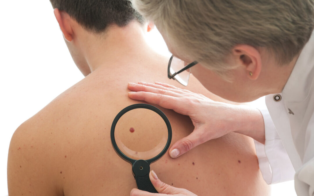 Spot the Melanoma: Warning Signs