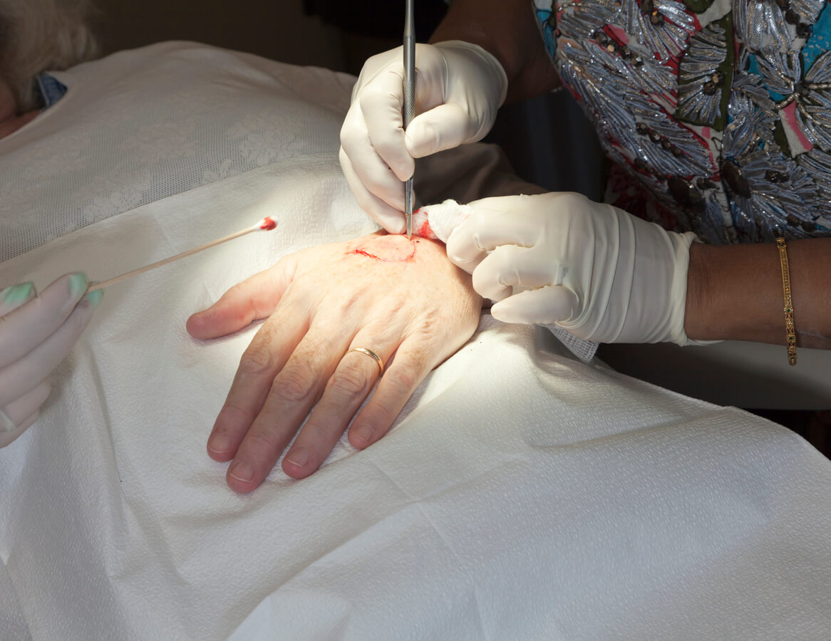 A patient undergoing Mohns surgery on their hand.