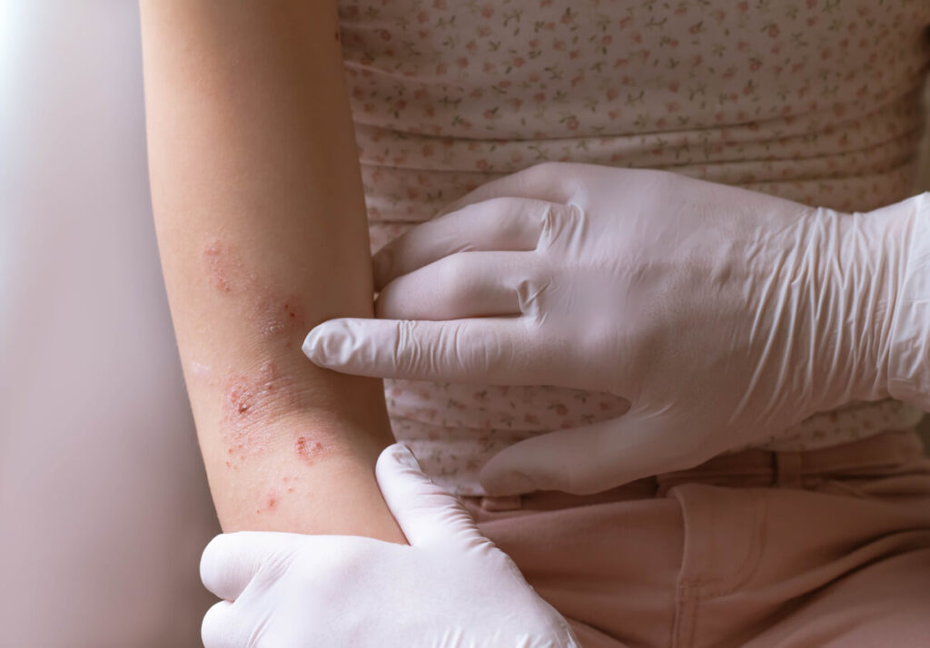 Most Common Skin Rashes Among Adults Georgia Skin Cancer And Aesthetic Dermatology 