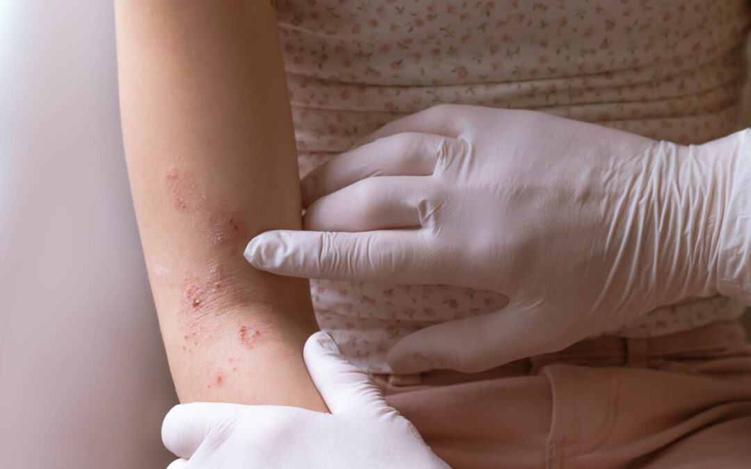 Most Common Skin Rashes Among Adults