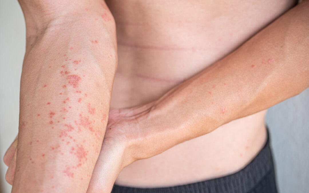 What Is Stasis Dermatitis?