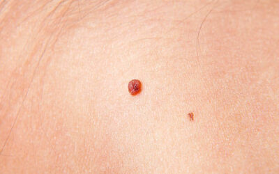 What Does Skin Cancer Look Like? Different Skin Cancer Signs