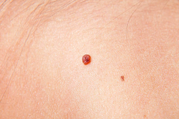 What Does Skin Cancer Look Like? Different Skin Cancer Signs